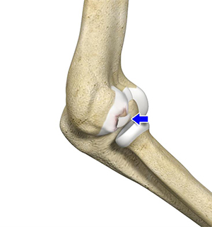 Osteochondritis Dissecans of the Capitellum