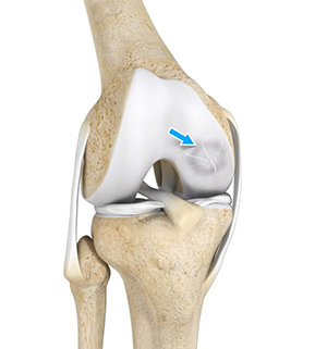 Osteochondritis Dissecans (OCD) – Femur and Patella