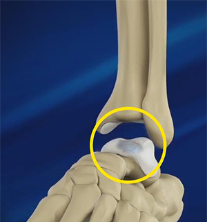 Osteochondritis Dissecans of the Talus