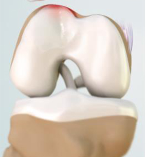 Patellar/Patellofemoral Instability