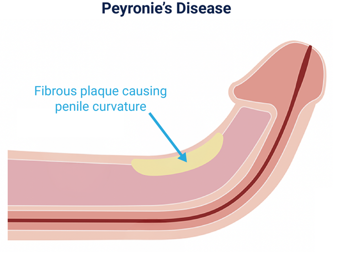 What Is Peyronie's Disease