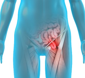 Abdominal/Inguinal Hernia Surgery pic