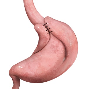 Anti-Reflux Surgery pic