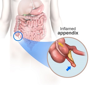 Appendicitis pic