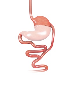 Biliopancreatic Diversion (BPD) pic