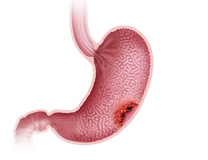 Gastric Cancer pic