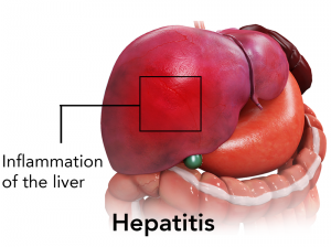 Hepatitis pic