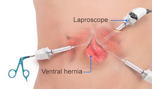 Hernia Surgery pic