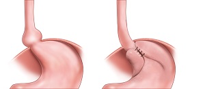 Hiatal Hernia Repair pic