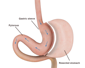 Laparoscopic Extended Sleeve Gastrectomy pic