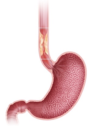 Oesophageal Cancer pic