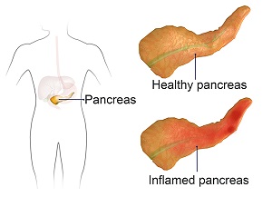 Pancreatitis pic