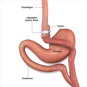 Revision Weight Loss Surgery pic