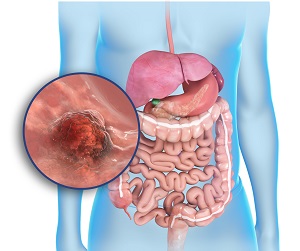 Stomach Cancer Surgery pic