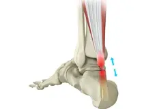 Picture of Achilles Tendon Rupture