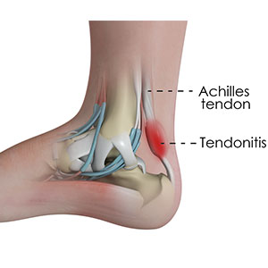 Picture of Achilles tendonitis