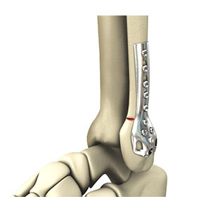 Picture of Ankle Fracture Surgery