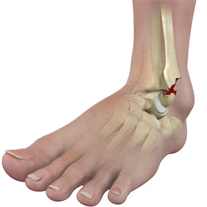 Picture of Ankle Fracture