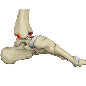 Picture of Ankle Impingement