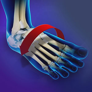 Picture of Ankle Instability
