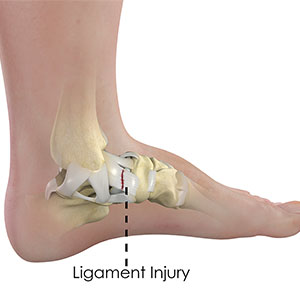 Picture of Ankle Ligament Injury
