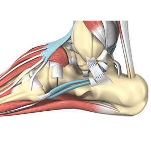 Picture of Ankle Ligament Reconstruction
