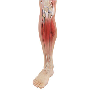 Picture of Shin Splints