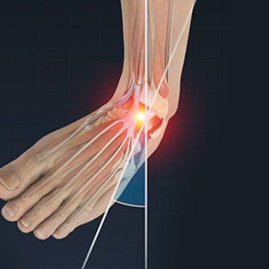 Picture of Ankle Sprain