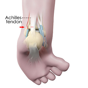 Picture of Ankle Tendonitis