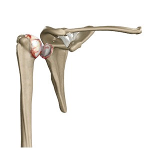Picture of Arthritis of the Shoulder