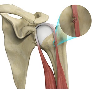 Picture of Bicep Tendon Rupture at Shoulder
