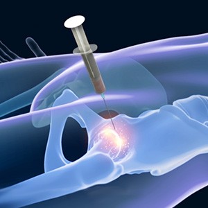 Picture of Bone Marrow Aspirate Concentrate (BMAC) Treatment