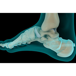 Picture of Calcaneal Fracture