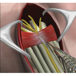 Picture of Carpal Tunnel Release Surgery
