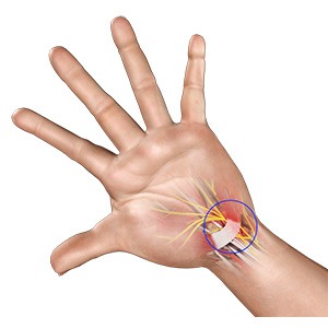 Picture of Carpal Tunnel Syndrome