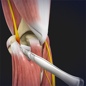 Picture of Cubital Tunnel Release (Medial Epicondylectomy)
