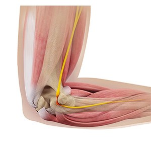 Picture of Cubital Tunnel Syndrome (Ulnar Nerve Entrapment)