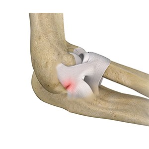 Picture of Elbow Ligament Injuries