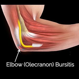 Picture of Elbow (Olecranon) Bursitis