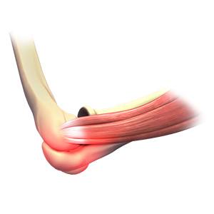 Picture of Elbow Sprain