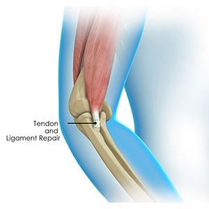Picture of Elbow Tendon and Ligament Repair
