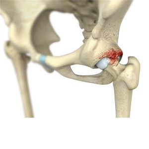 Picture of Femoroacetabular Impingement