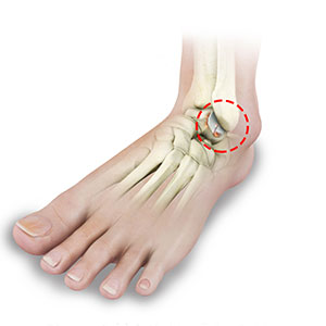 Picture of Foot and Ankle Arthritis