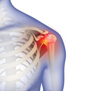 Picture of Frozen Shoulder