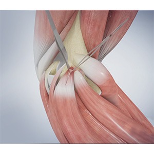 Picture of Golfer’s Elbow Surgery