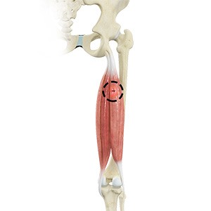 Picture of Hamstring Injuries