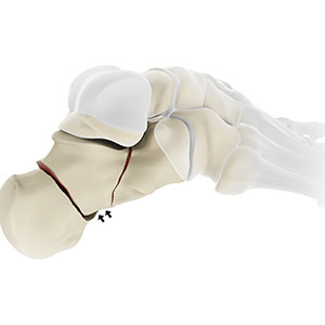 Picture of Heel Fracture