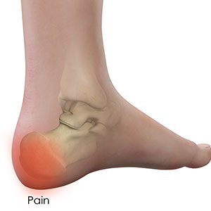Picture of Heel Pain