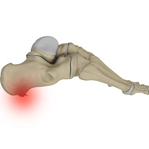 Picture of Heel Spurs