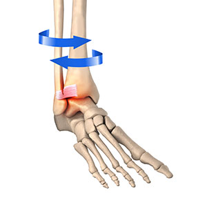 Picture of High Ankle Sprain
